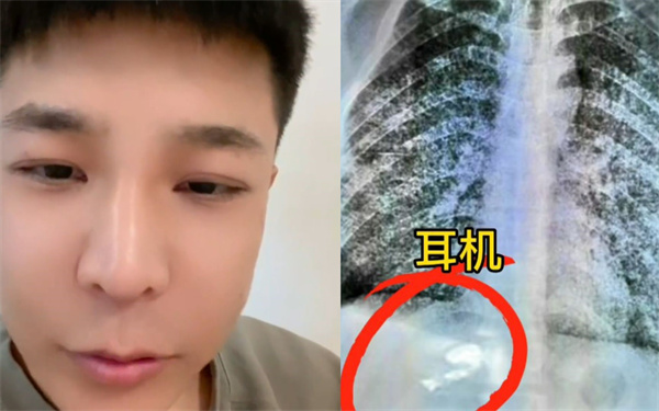 男子误吞耳机肚子传出歌声